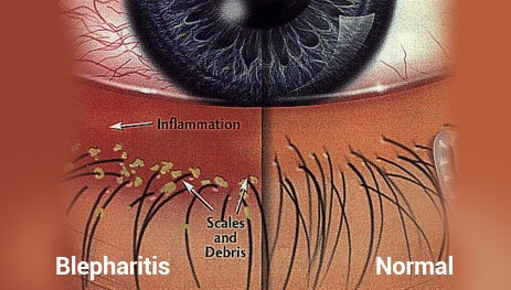 Close-up comparison of eyelid with blepharitis vs. normal eyelid, showing clogged glands and inflammation near eyelashes