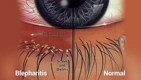 What is Eyelid Hygeine?
