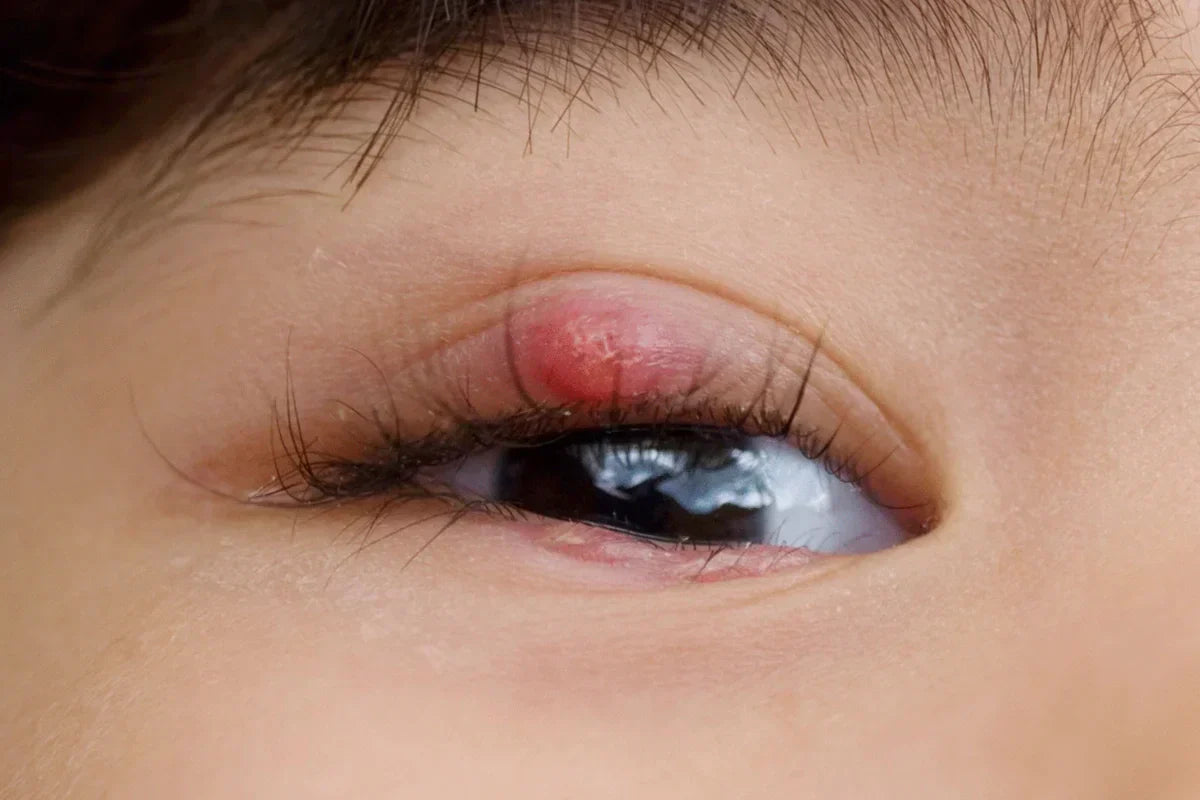 Close-up of a swollen red stye on the upper eyelid of a person's eye