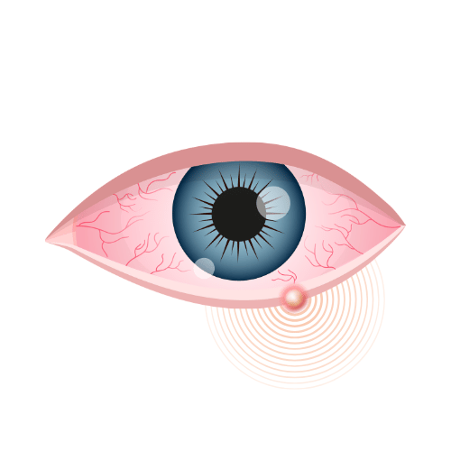 Helps with Styes